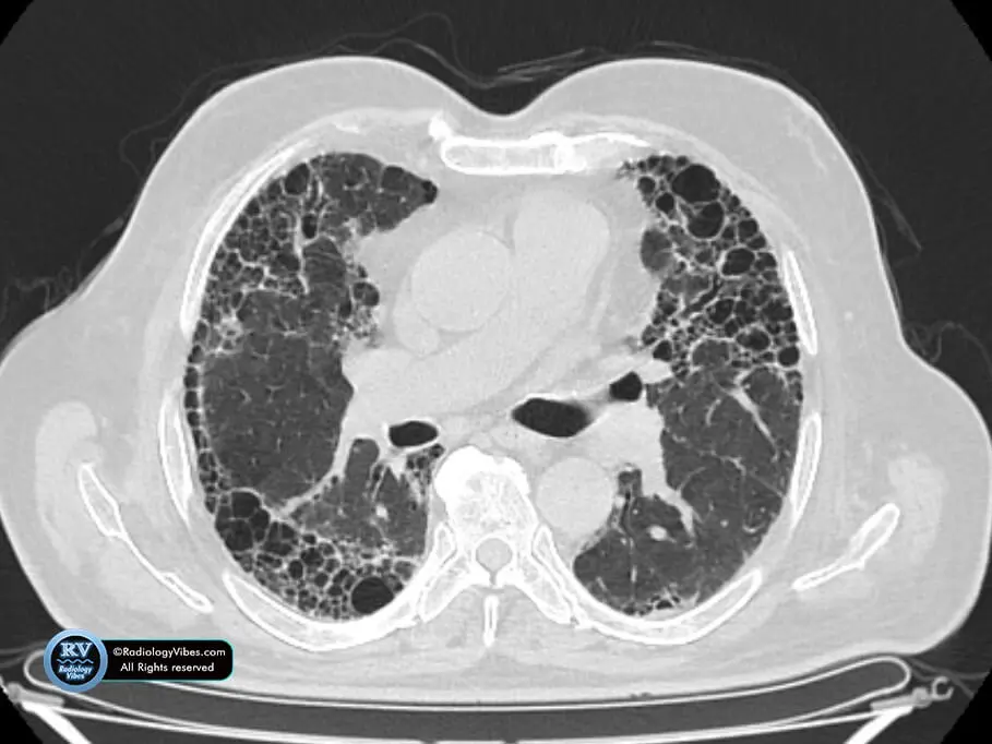 Uip Radiographic Radiology Vibes | Online Learning Platform For Radiologists.